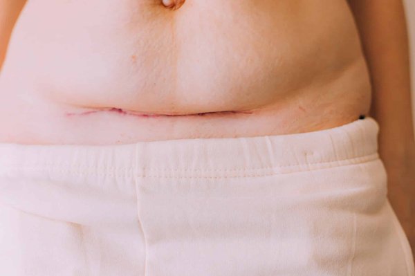 Cicatrice cheloïde : stratégies pour un traitement adapté